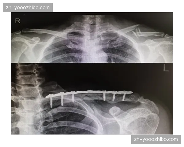 浙江宁方泽锁骨骨折休养 年轻边锋长期伤停影响U23政策